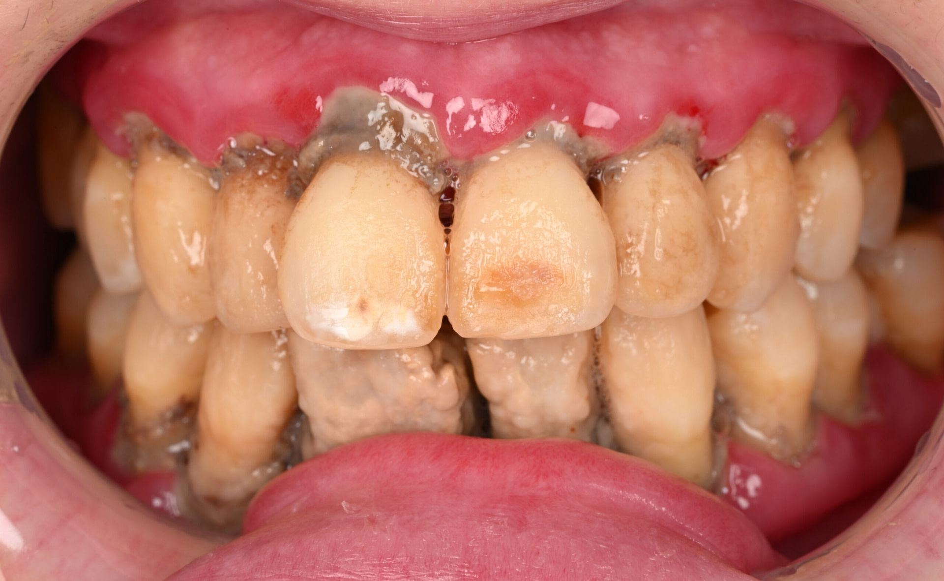 rodin-soft-reline-kit-3d-printed-dentures-workflow-blog-idd-institute-of-digital-dentistry-patient-diagnosis-before-periodontal-disease