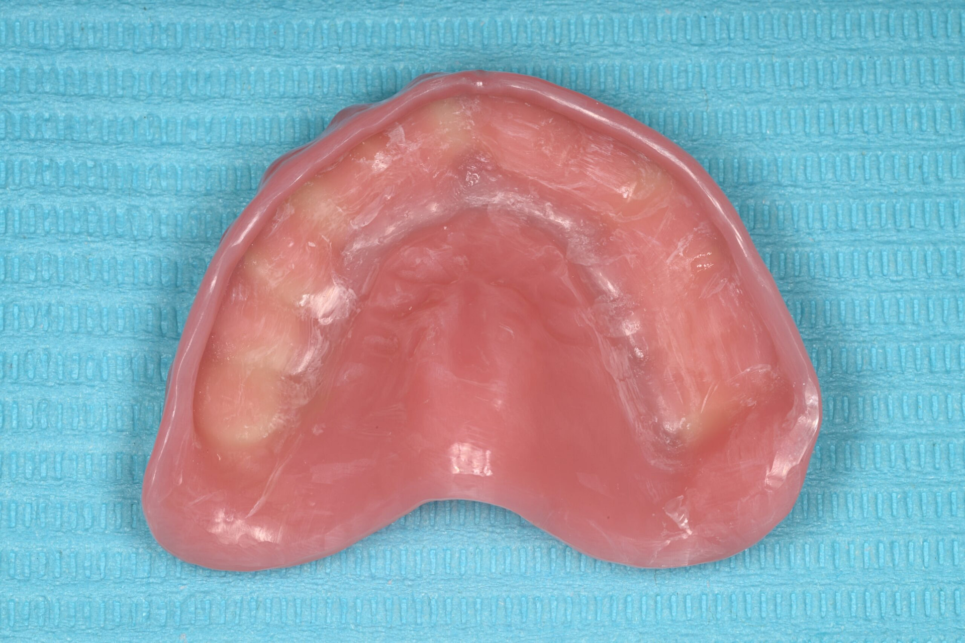 rodin-soft-reline-kit-3d-printed-dentures-workflow-blog-idd-institute-of-digital-dentistry-upper-denture-adhesive-primer-intaglio-surface-application