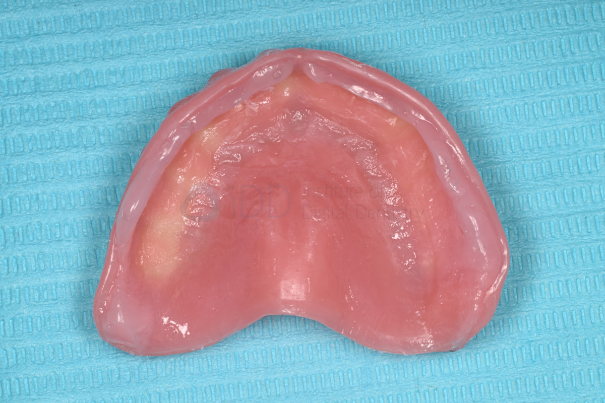 rodin-soft-reline-kit-3d-printed-dentures-workflow-blog-idd-institute-of-digital-dentistry-upper-denture-soft-reline-material-intaglio-surface-application