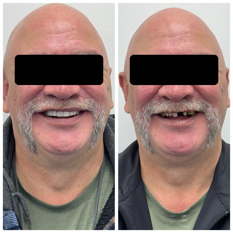 dental-implant-cases-before-and-after-cases3