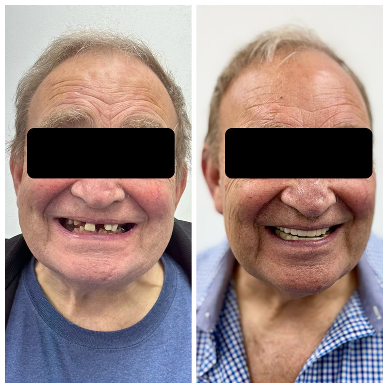 dental-implant-cases-before-and-after1