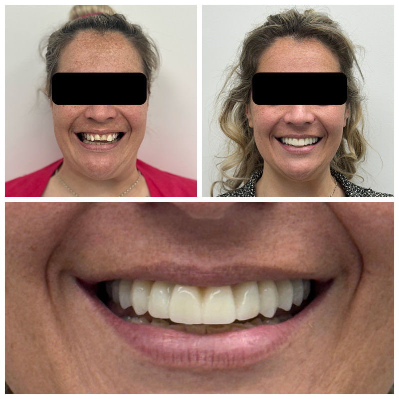 dental-implant-cases-before-and-after2