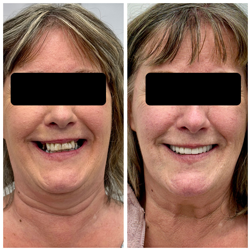 dental-implant-cases-before-and-after3