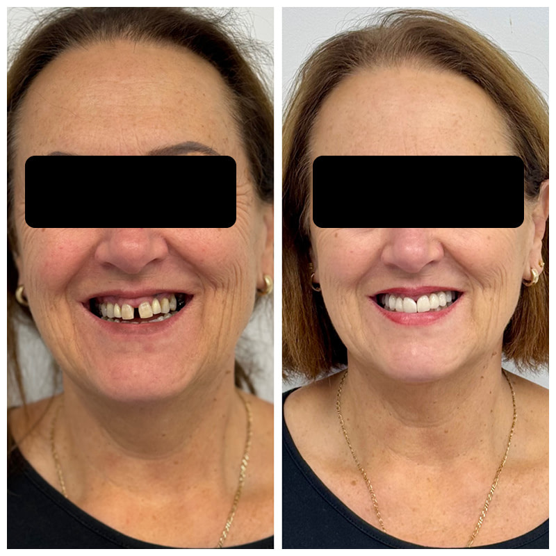 dental-implant-cases-before-and-after4