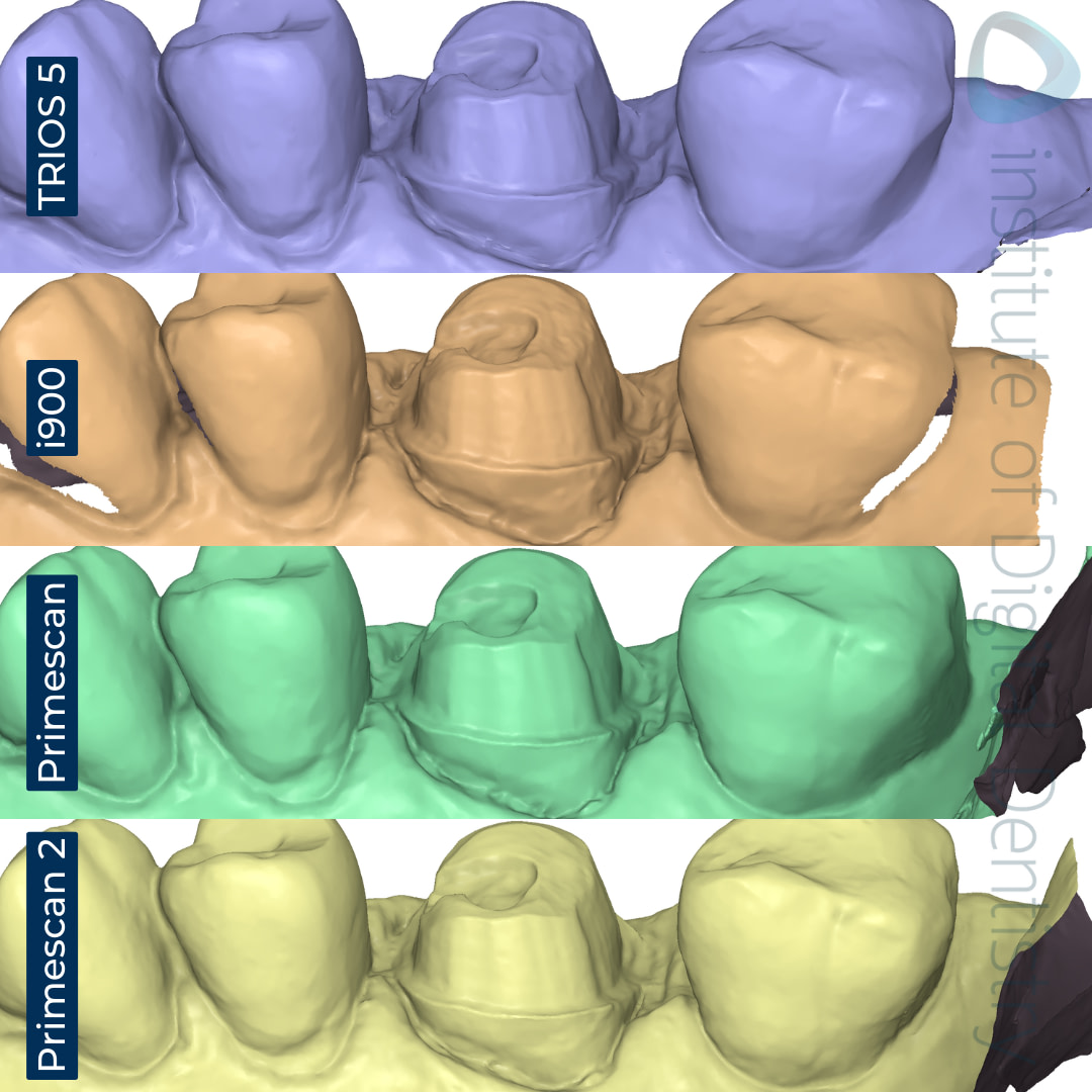 dentsply-sirona-primescan-2-3shape-trios-5-medit-i900-cerec-primescan-intraoral-scanner-comparison-idd-compares-institute-of-digital-dentistry-blog-buccal-margin-prep