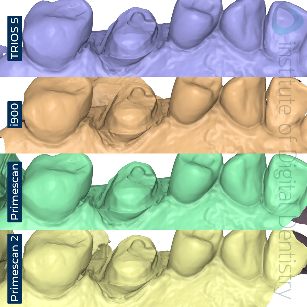 dentsply-sirona-primescan-2-3shape-trios-5-medit-i900-cerec-primescan-intraoral-scanner-comparison-idd-compares-institute-of-digital-dentistry-blog-palatal-margin-prep