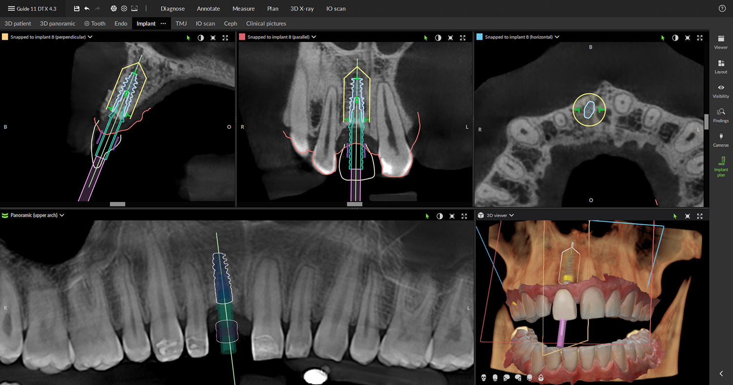 dexis_3800_DTX_studio_clinic_iDD_review_digital_dentistry4