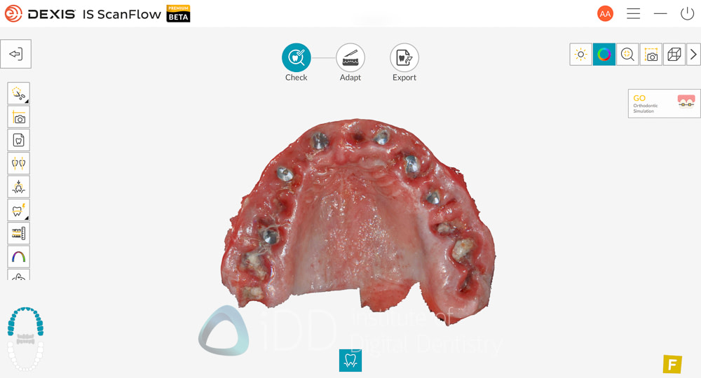 dexis_3800_wireless_intraoral_scanner_review_institute_of_Digital_dentistry15