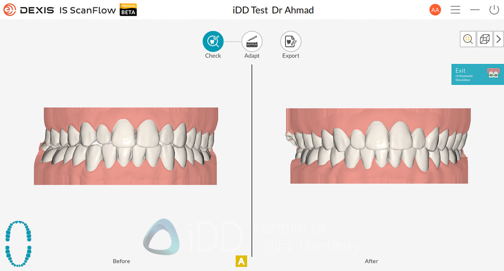 dexis_3800_wireless_intraoral_scanner_review_institute_of_Digital_dentistry19