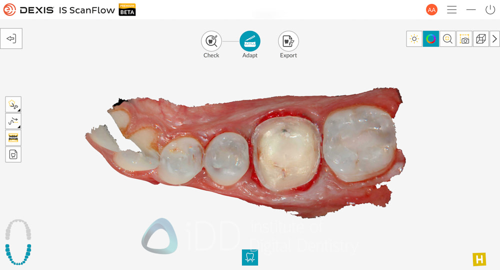 dexis_3800_wireless_intraoral_scanner_review_institute_of_Digital_dentistry24