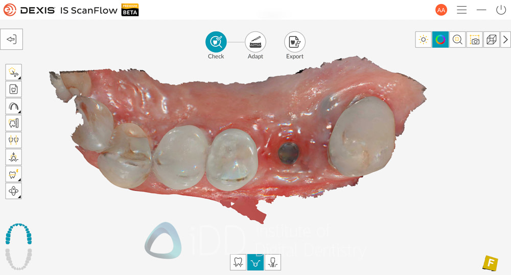 dexis_3800_wireless_intraoral_scanner_review_institute_of_Digital_dentistry6