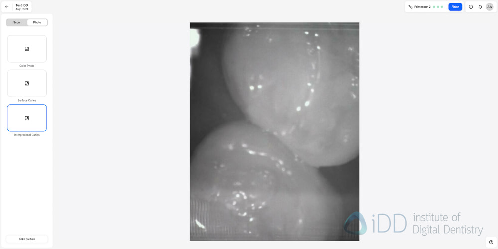 primescan_2_software_scan_caries2