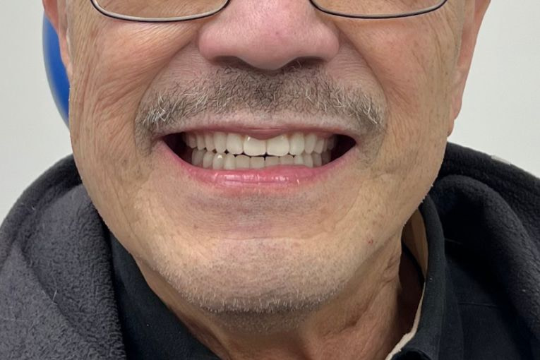 Transitioning to Full Digital Dentures using 3Shape Dental System (2)