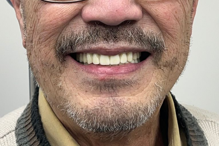 Transitioning to Full Digital Dentures using 3Shape Dental System