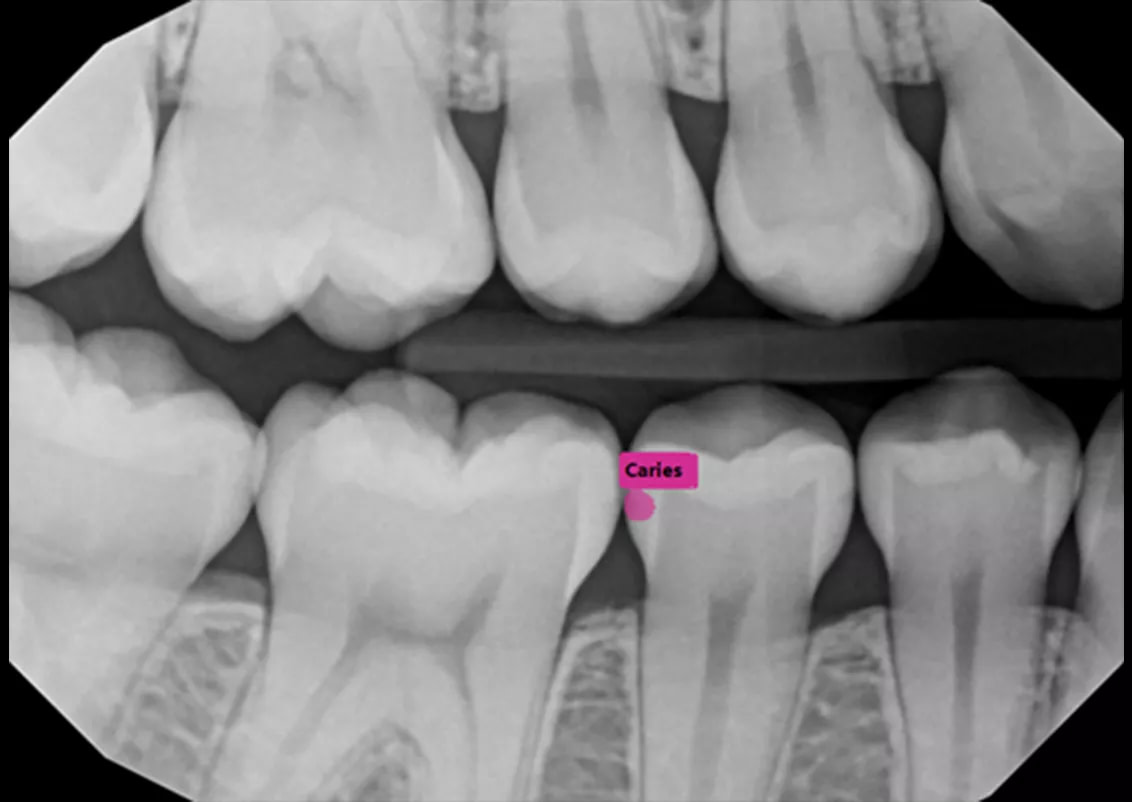 dexis-ai-dtxassist-caries-idd-digital-dentistry-decoded-podcast-jordan-reiss
