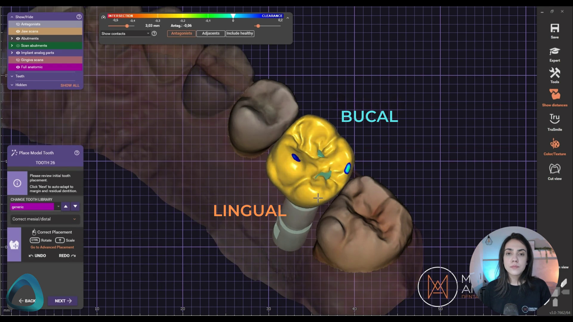 exocad bucal lingual