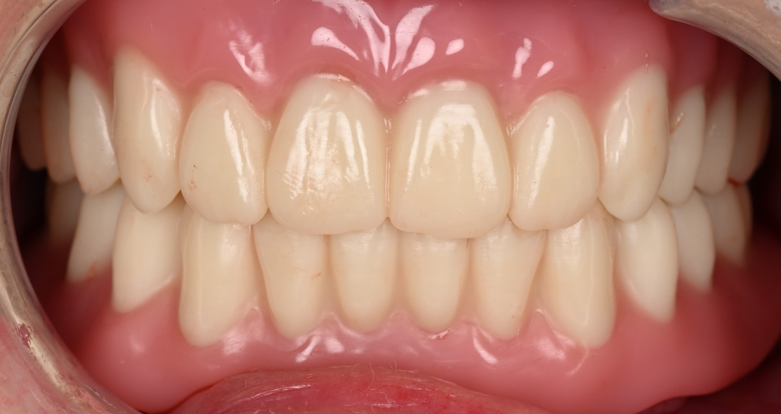 final_rodin_denture_reline