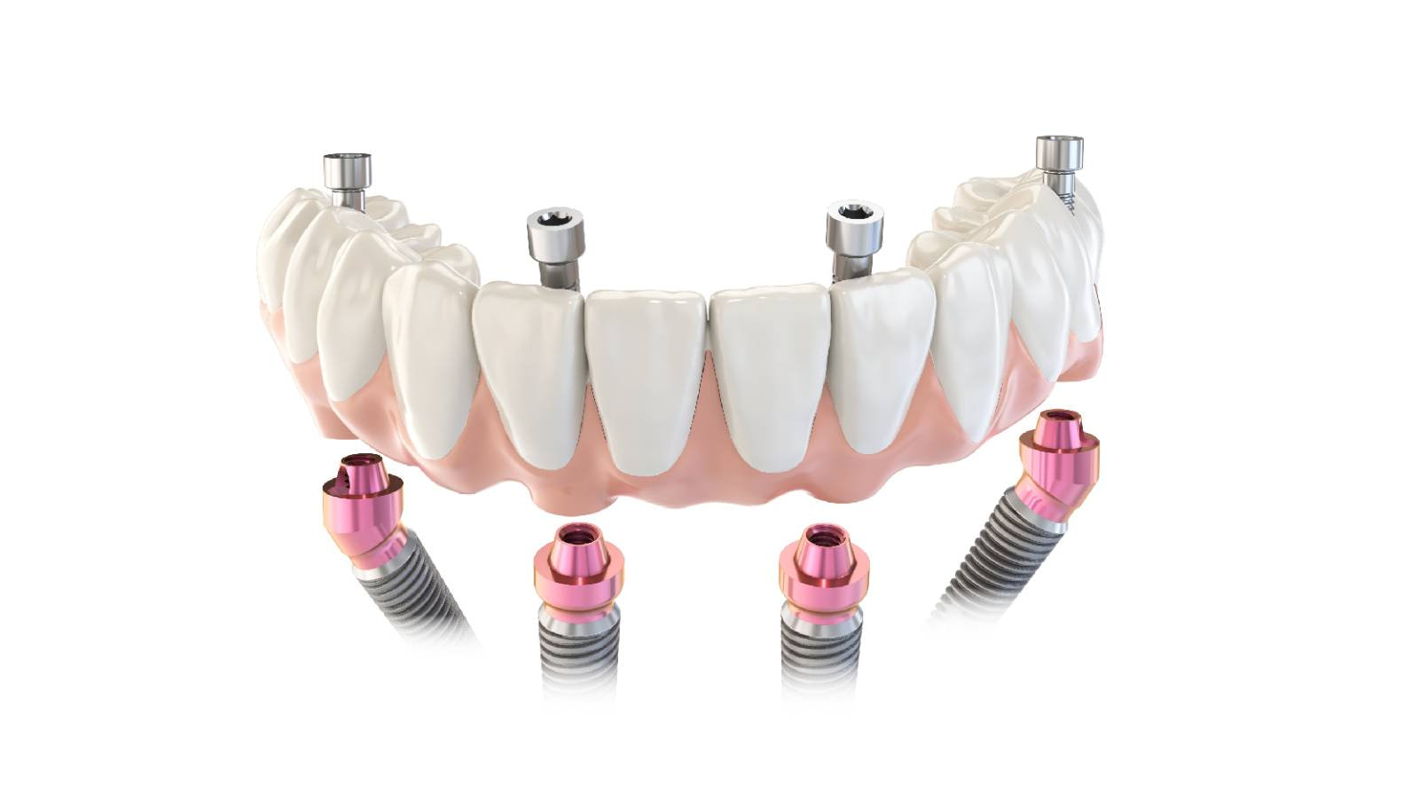 DDD-Podcast-S2E6-tri-dental-all-on-x-implants-idd-institute-of-digital-dentistry