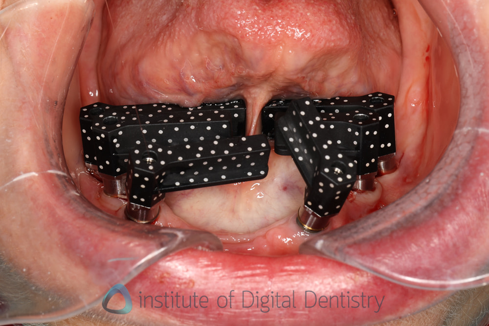 shining_3D_aoralscan_elite_review_institute_of_digital_dentistry13