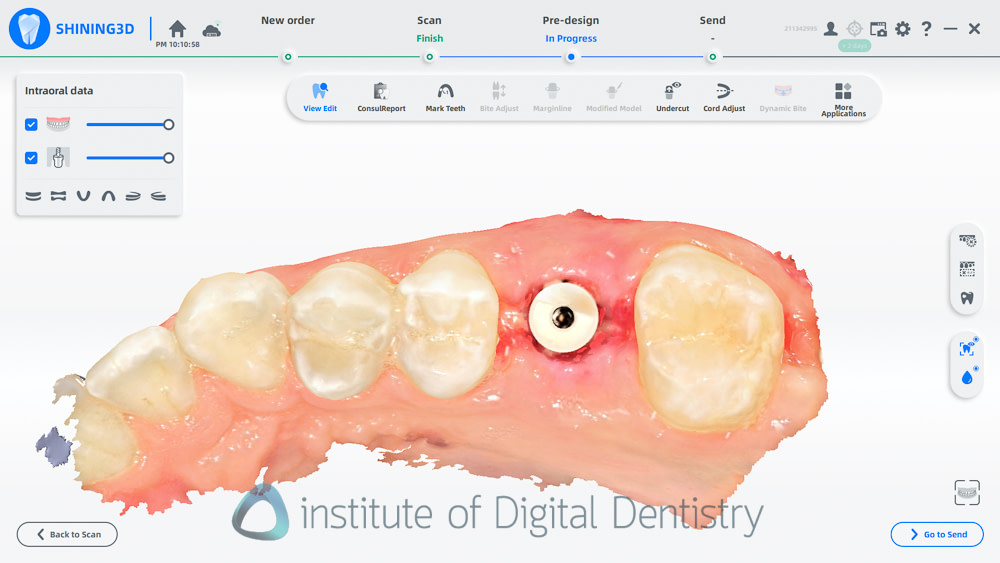 shining_3D_aoralscan_elite_review_institute_of_digital_dentistry56