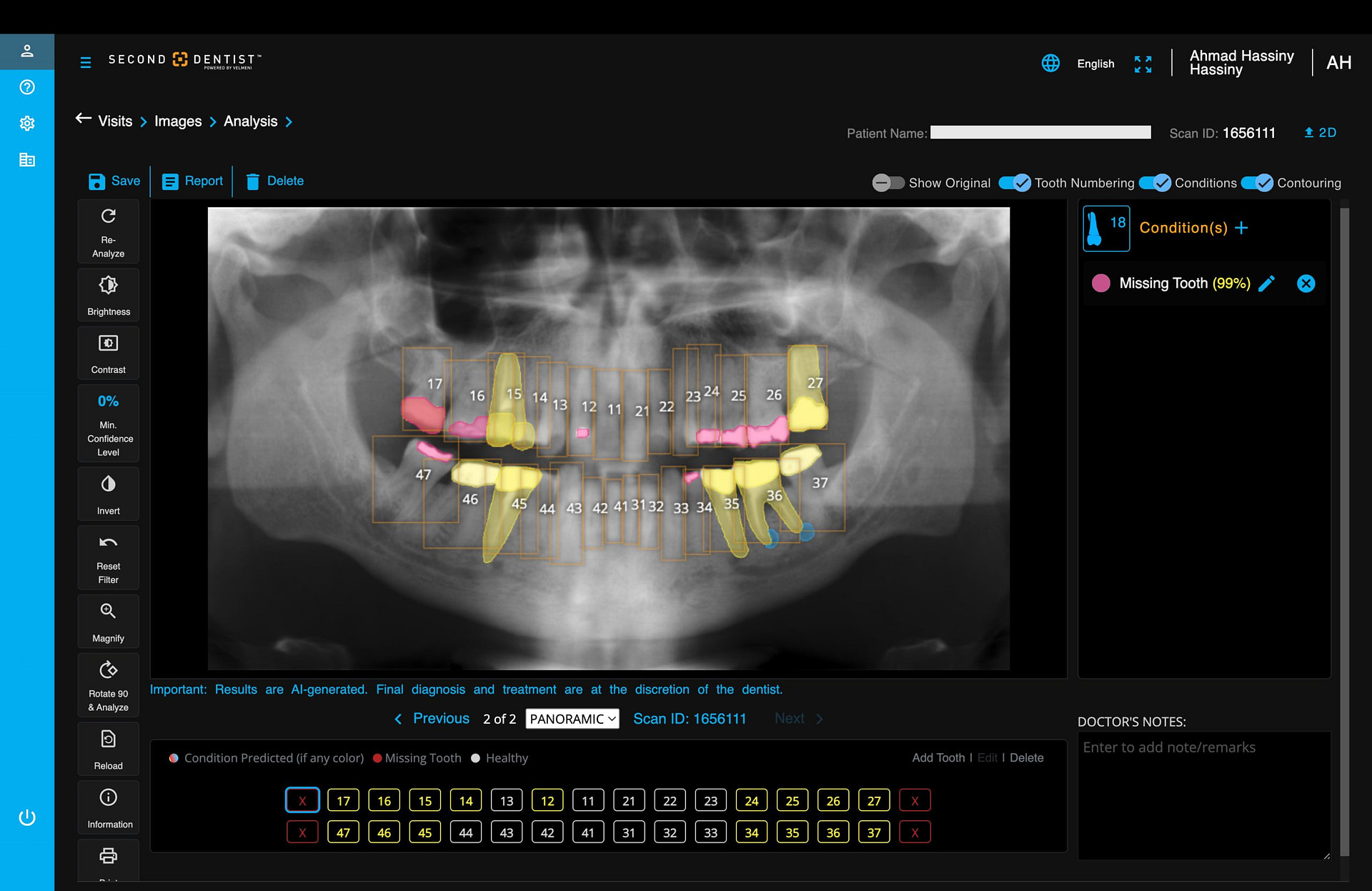 velmeni-second-dentist-ai-review-blog-idd-institute-of-digital-dentistry-software-image-analysis-panoramic-condition