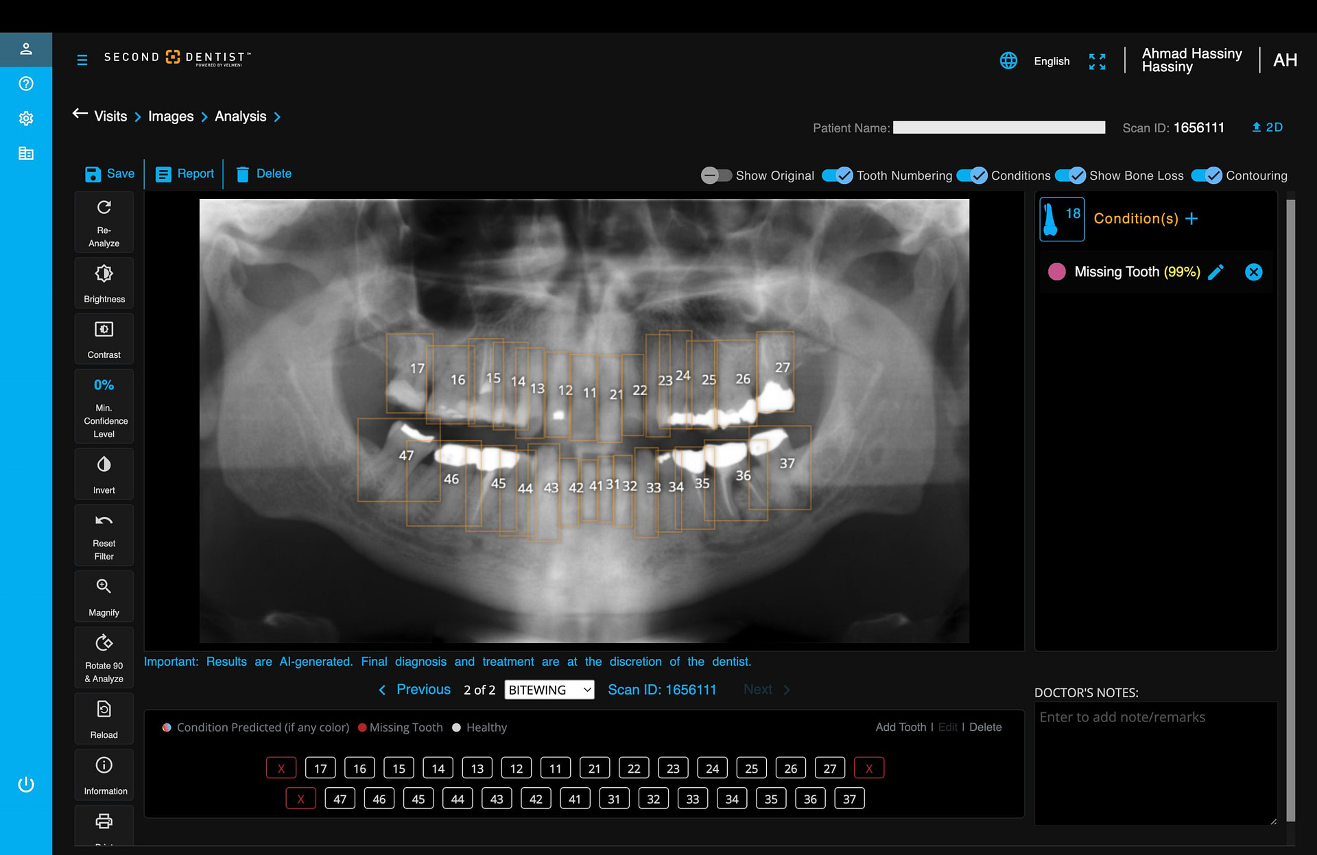 velmeni-second-dentist-ai-review-blog-idd-institute-of-digital-dentistry-software-patient-missing-tooth