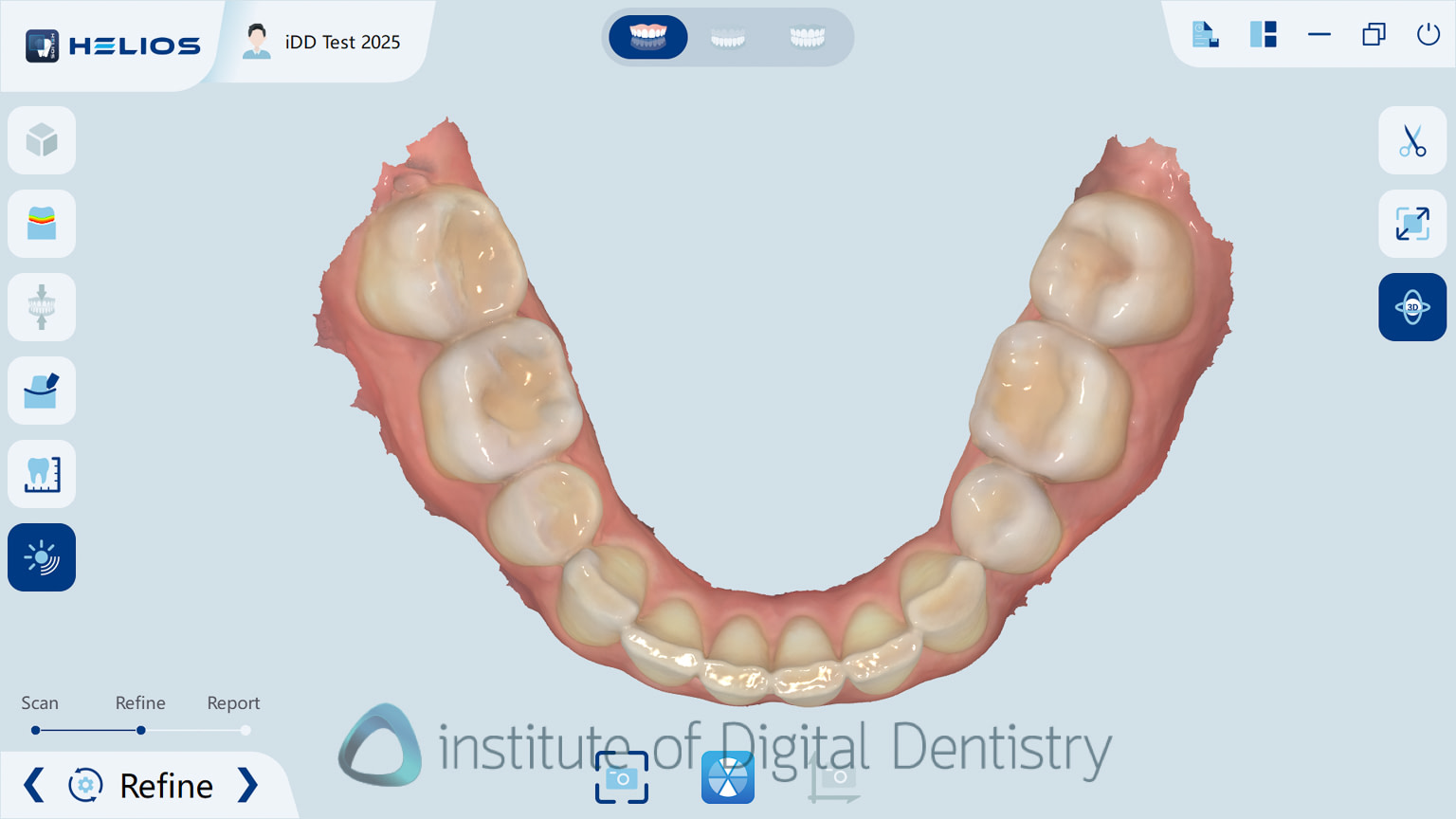 helios_500_review_intra_oral_scanner_iDD11