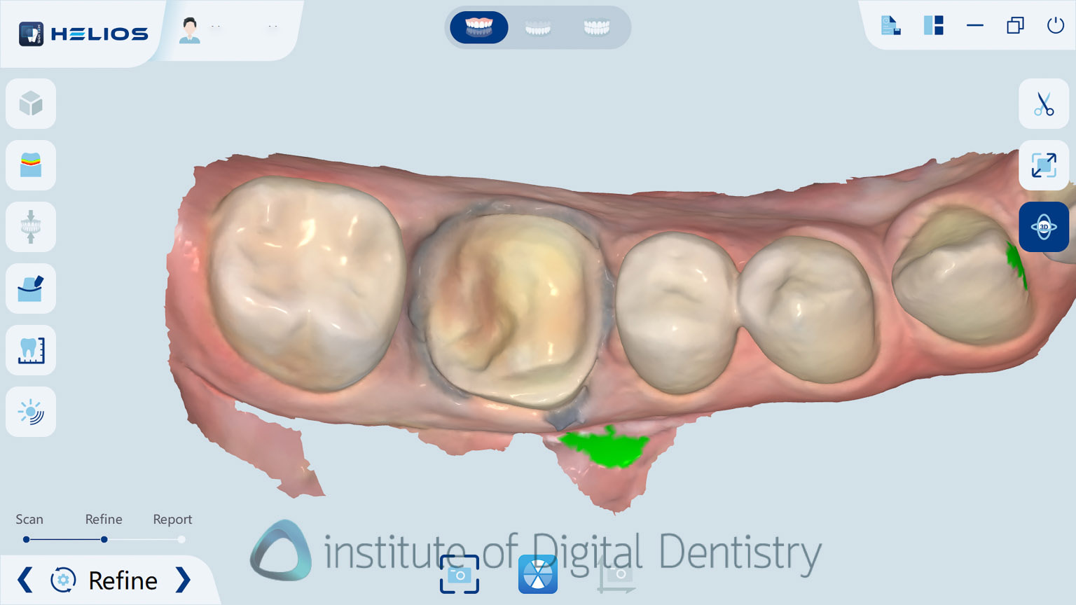 helios_500_review_intra_oral_scanner_iDD18