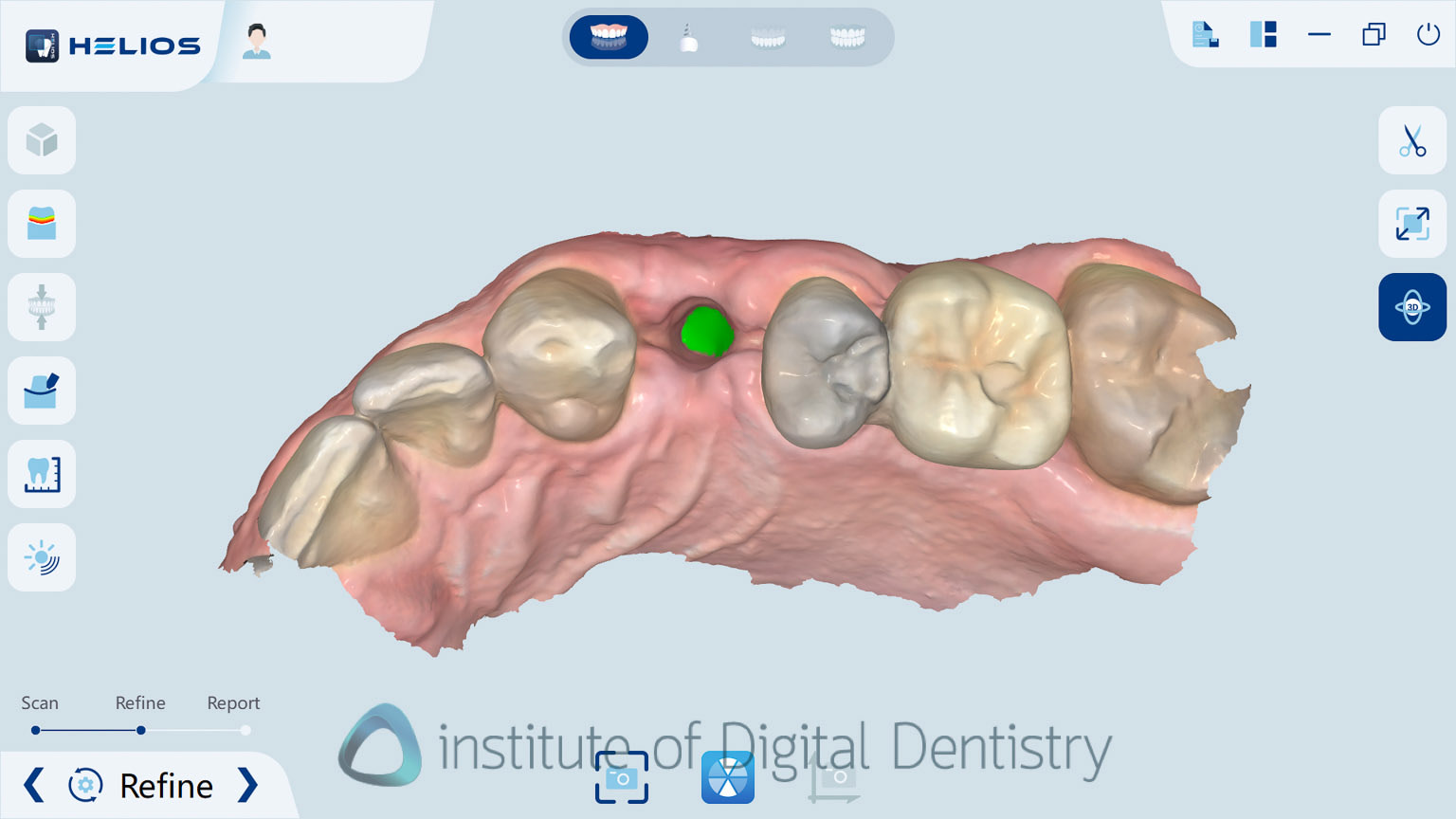 helios_500_review_intra_oral_scanner_iDD21
