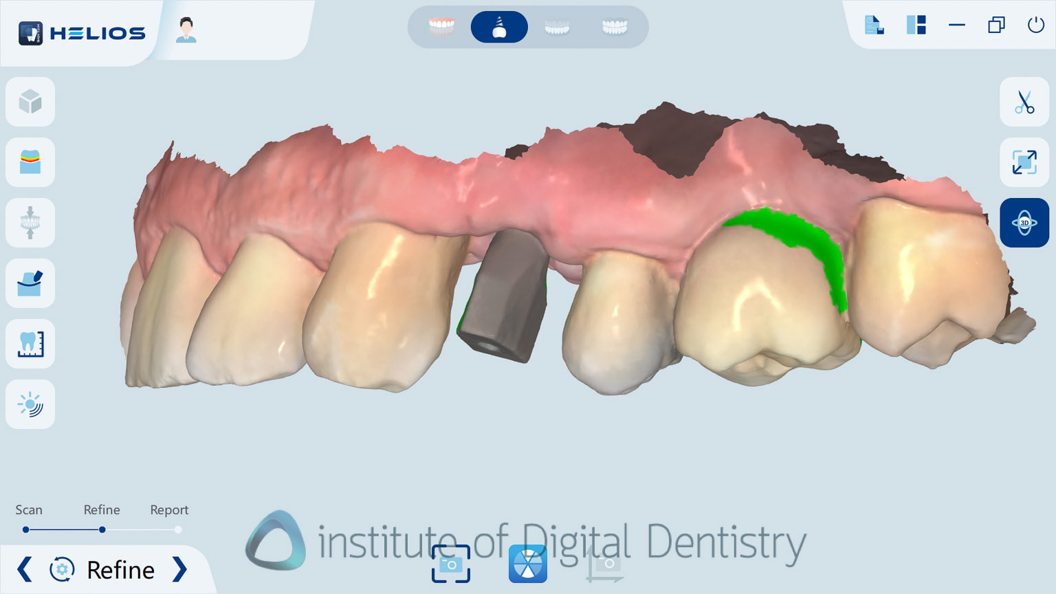 helios_500_review_intra_oral_scanner_iDD22