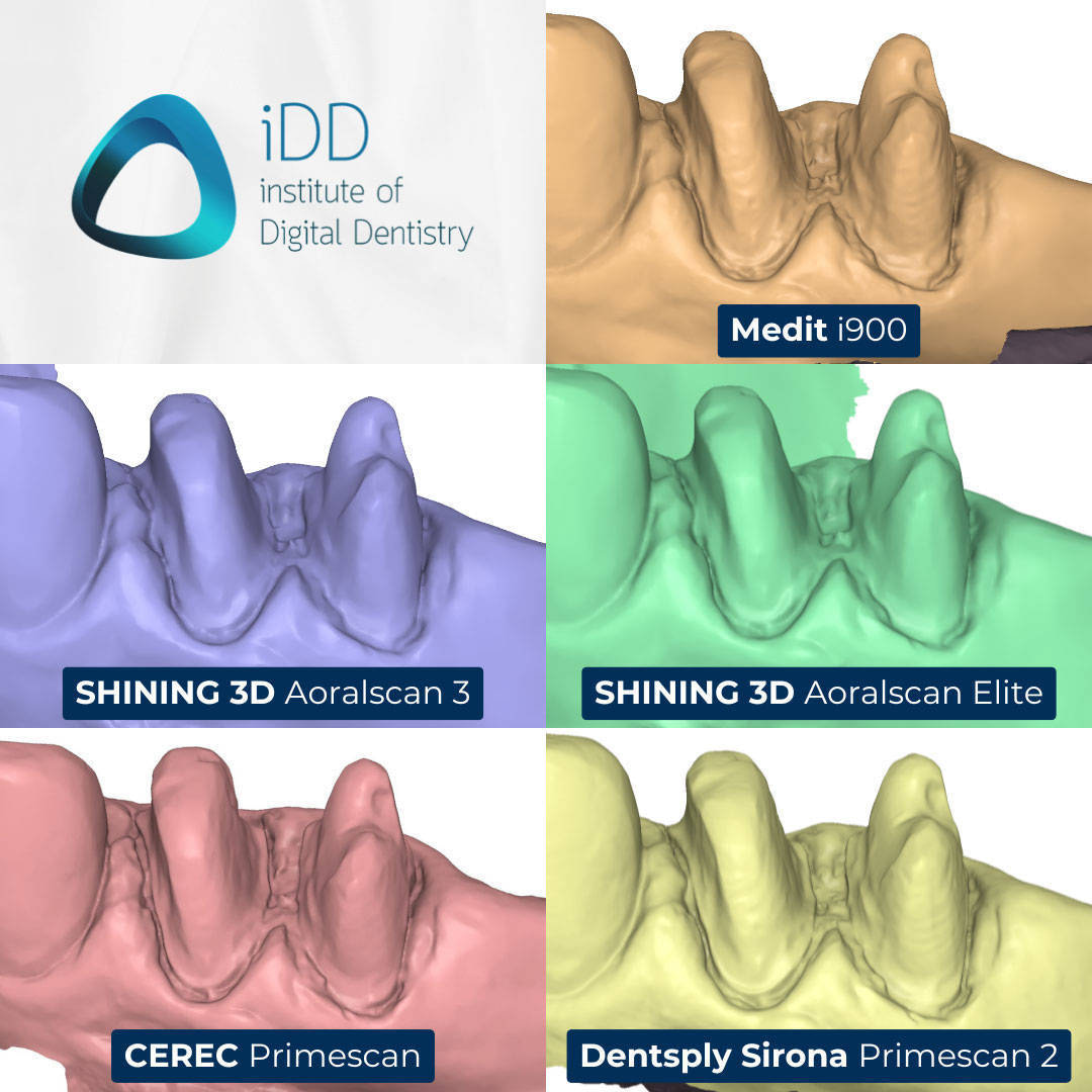 iDD_Compares_stl-scan-view-buccal-margin-prep-view