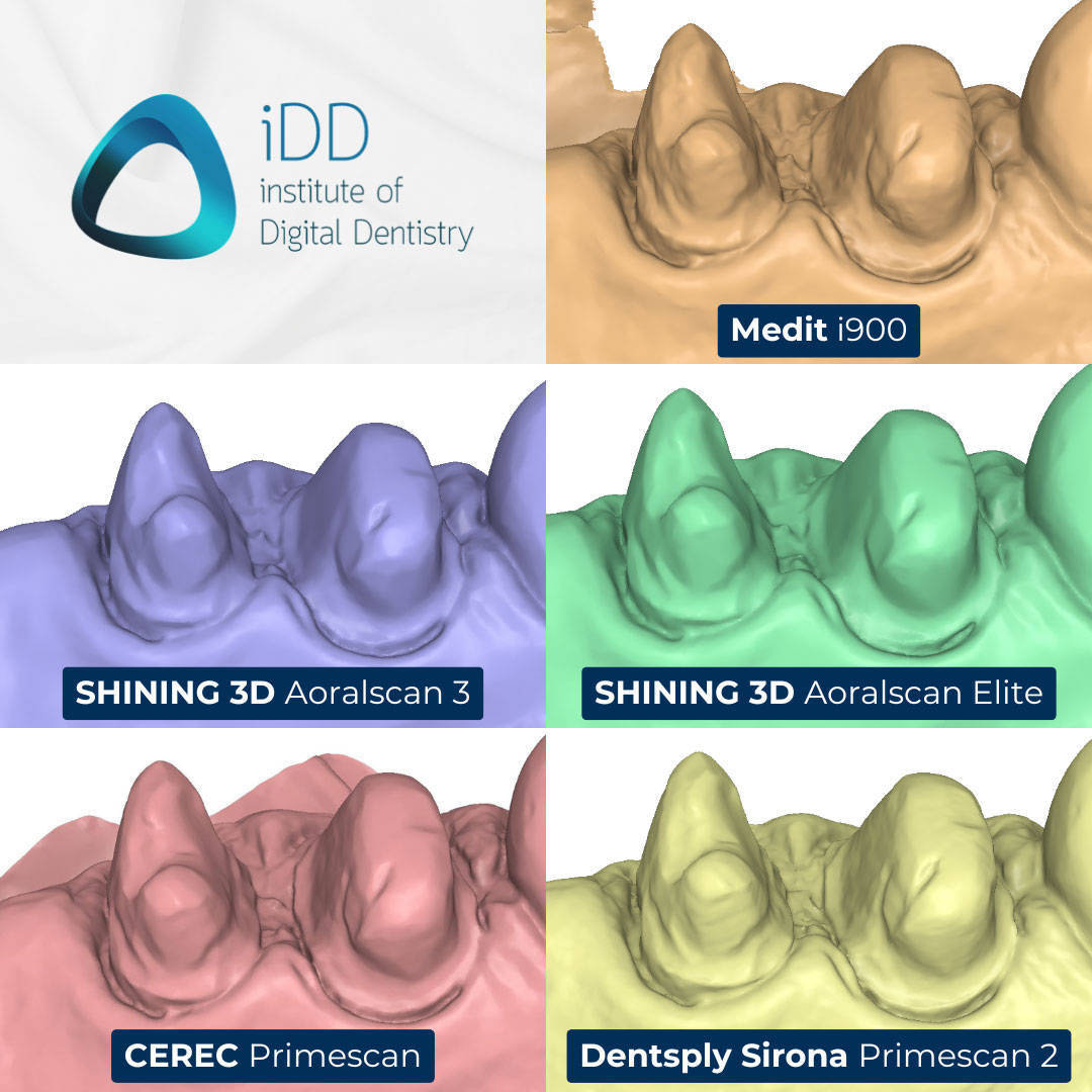 iDD_Compares_stl-scan-view-palatal-margin-prep-view