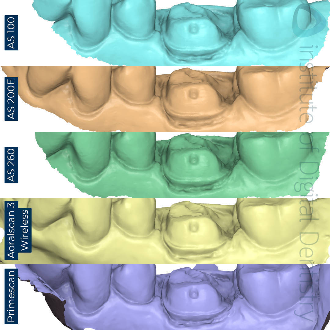 Buccal-margin-prep-Alliedstar-AS-100-AS200E-AS-260-SHINING-3D-Aoralscan-3-Wireless-Dentsply-Sirona-CEREC-Primescan-iDD-Compares-Institute-of-Digital-Dentistry-1x1-1