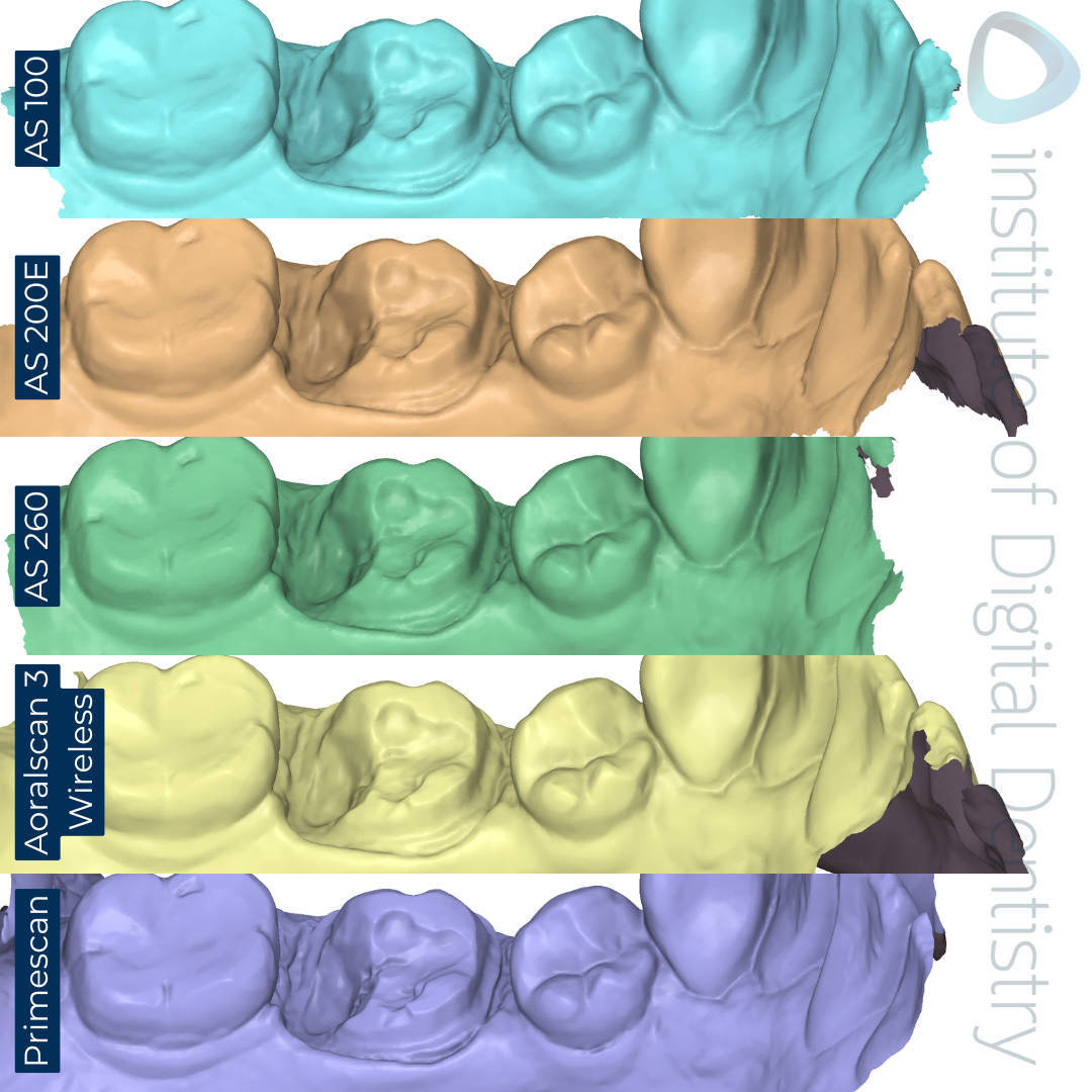 Lingual-margin-prep-Alliedstar-AS-100-AS200E-AS-260-SHINING-3D-Aoralscan-3-Wireless-Dentsply-Sirona-CEREC-Primescan-iDD-Compares-Institute-of-Digital-Dentistry-1x1-1
