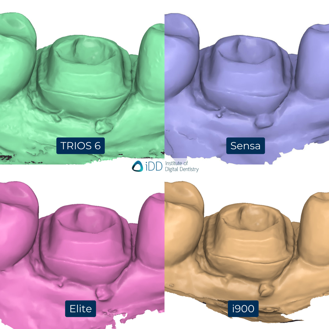5-3Shape-TRIOS-6-Alliedstar-Sensa-Shining-3D-Aoralscan-Elite-Medit-i900-intraoral-scanner-ios-idd-compares-lower-stl-scan-buccal-margin-prep-view