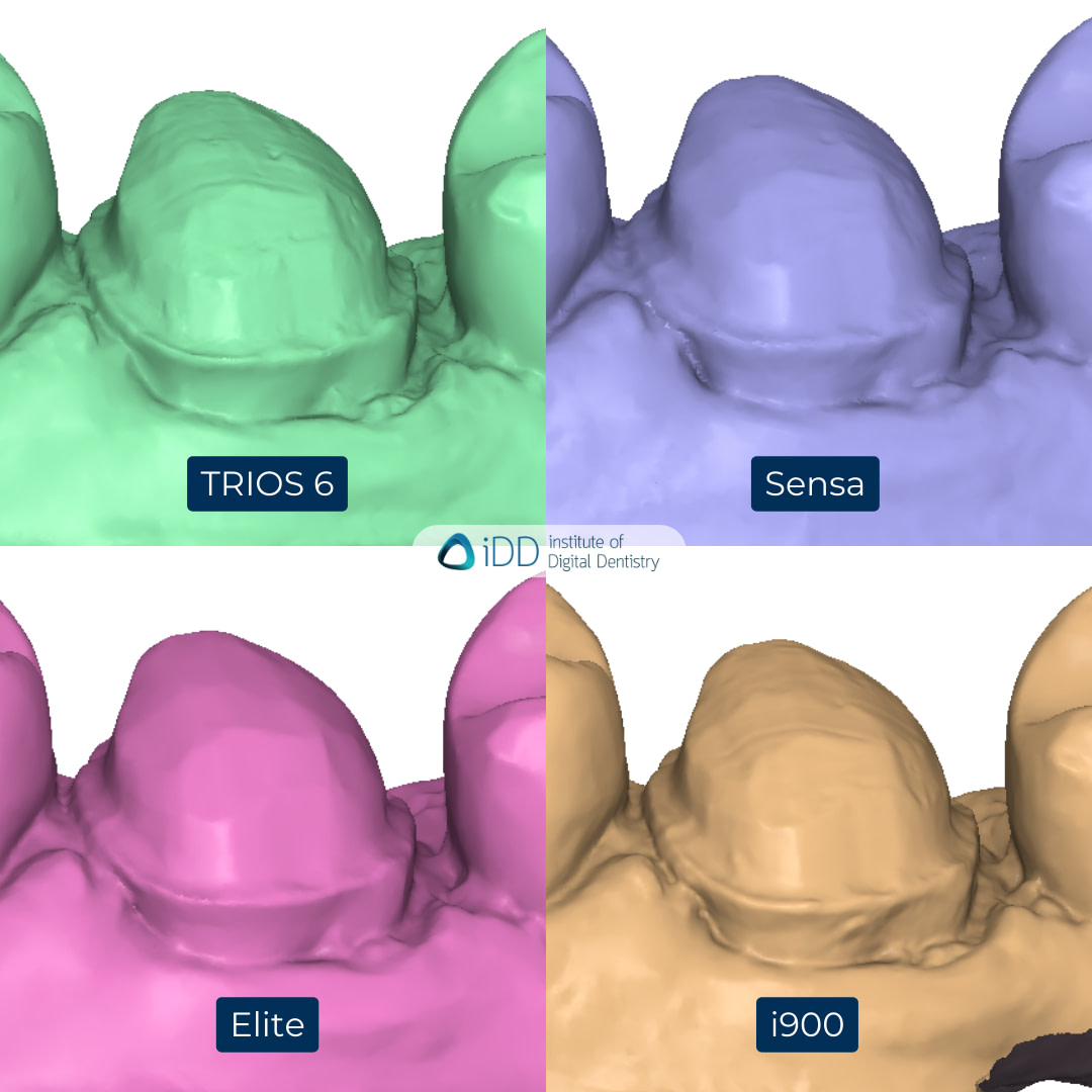 5-3Shape-TRIOS-6-Alliedstar-Sensa-Shining-3D-Aoralscan-Elite-Medit-i900-intraoral-scanner-ios-idd-compares-upper-stl-scan-buccal-margin-prep-view