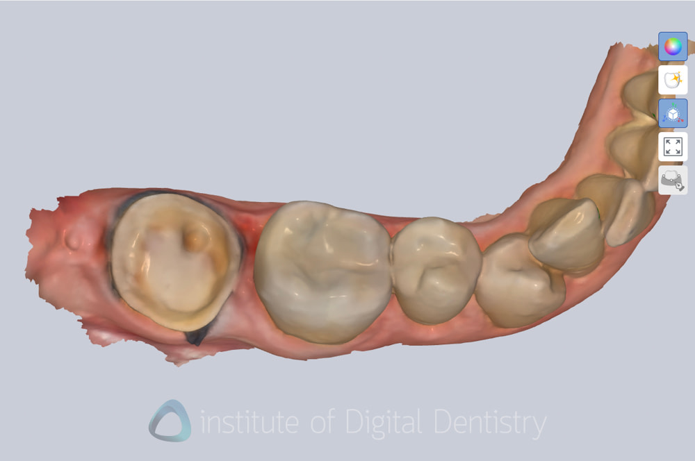 alliedstar_sensa_intraoral_scanner_review_iDD (15)