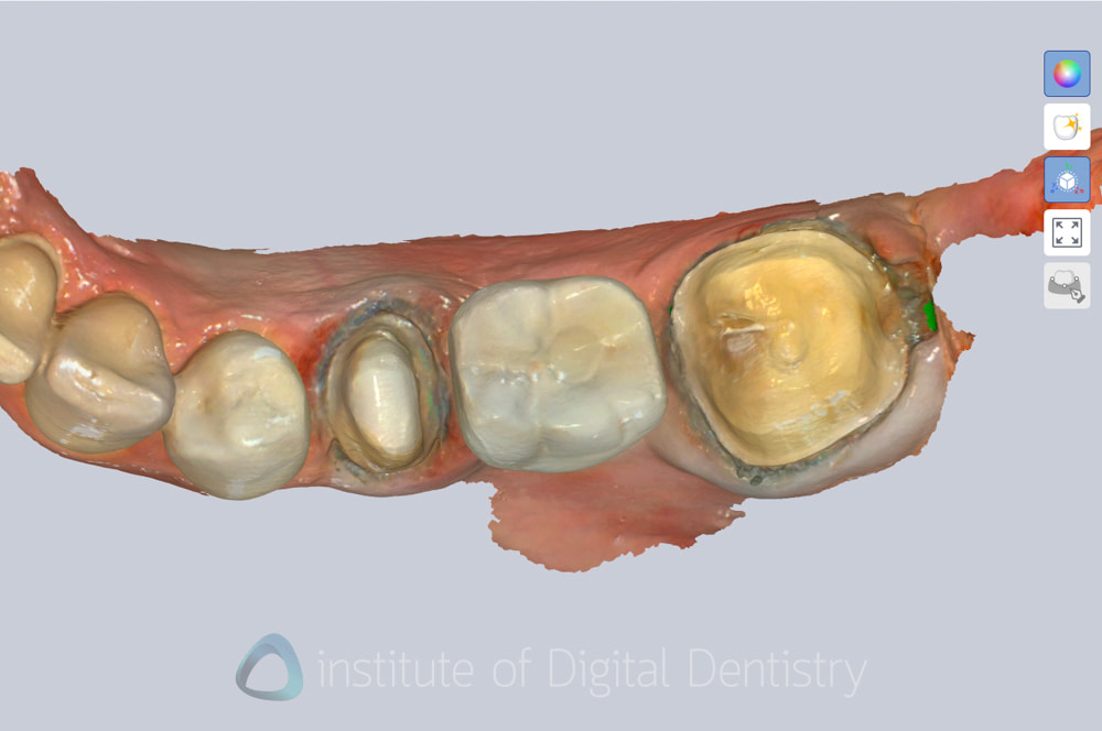 alliedstar_sensa_intraoral_scanner_review_iDD (16)