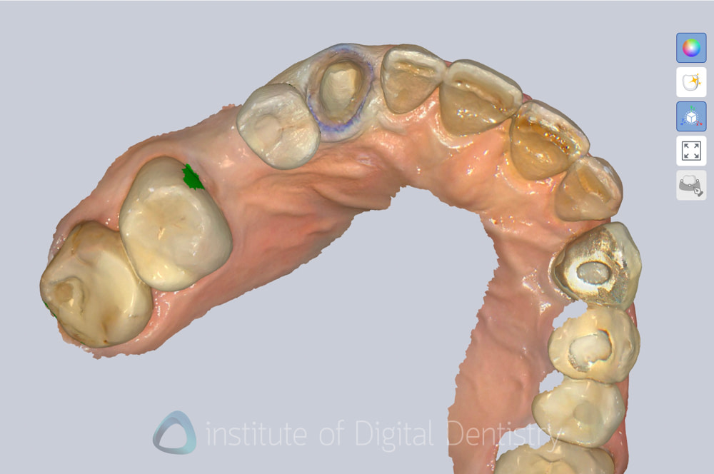 alliedstar_sensa_intraoral_scanner_review_iDD (17)
