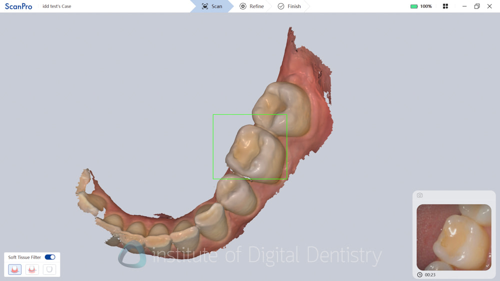 alliedstar_sensa_intraoral_scanner_review_iDD (7)
