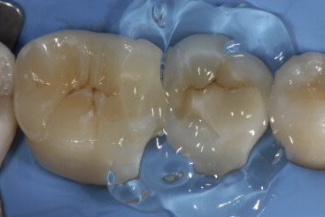 Luting-composite-is-polymerized-with-a-curing-device-at-least-60s-per-surface-and-finally