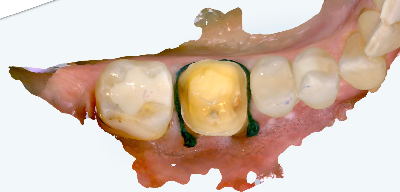 itero_design_suite_Lumina_iDD1