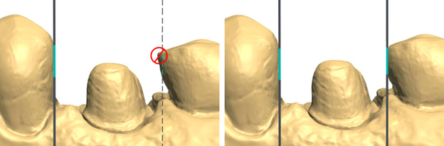 top five mistakes when scanning institute of digital dentistry (1)