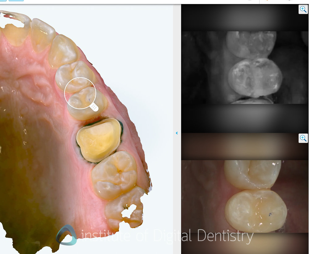itero_lumina_iDD_review_institute_of_digital_dentistry_align_technology45