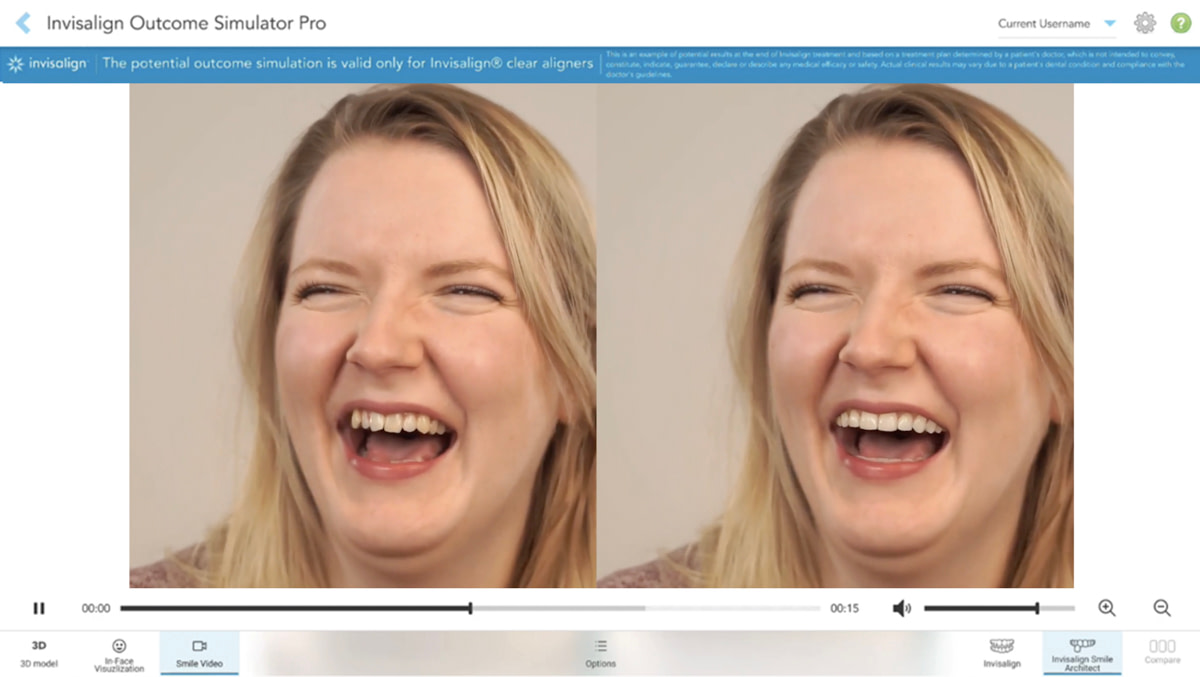 IOSIM Pro Smile Video