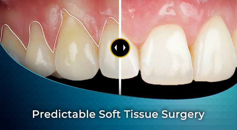 Predictable Soft Tissue Surgery | Institute of Digital Dentistry