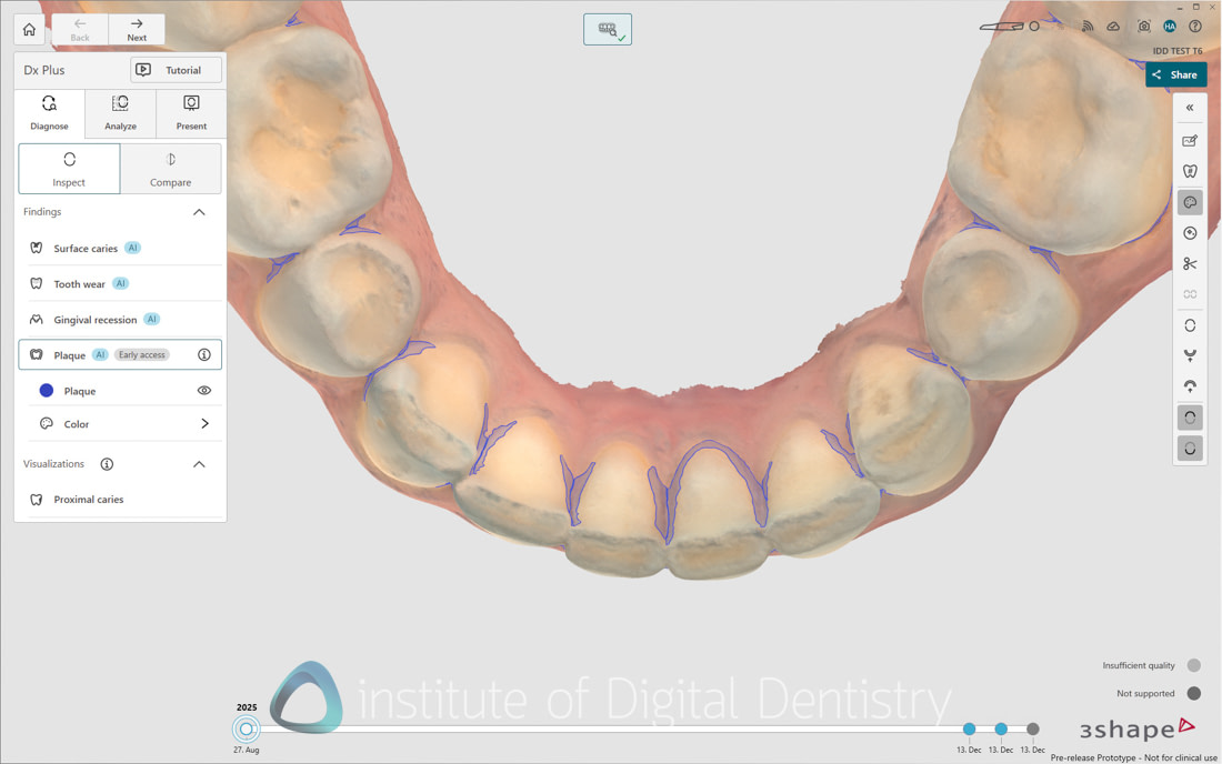 3Shape_TRIOS_6_Review_IDD_Software50