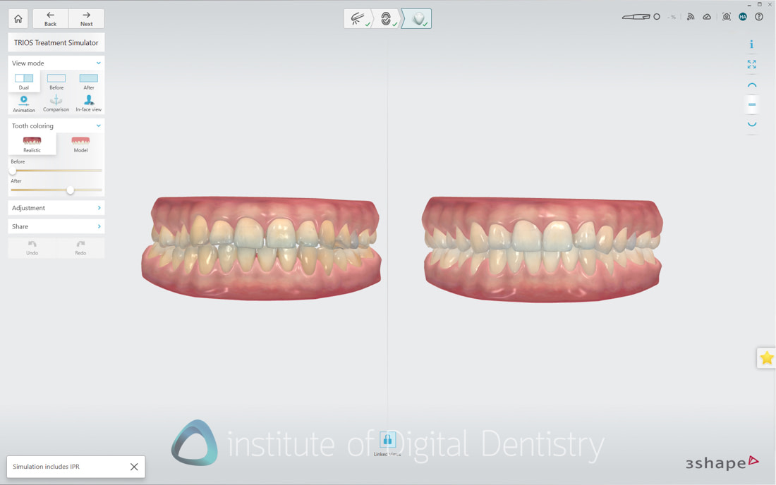 3Shape_TRIOS_6_Review_IDD_Software52