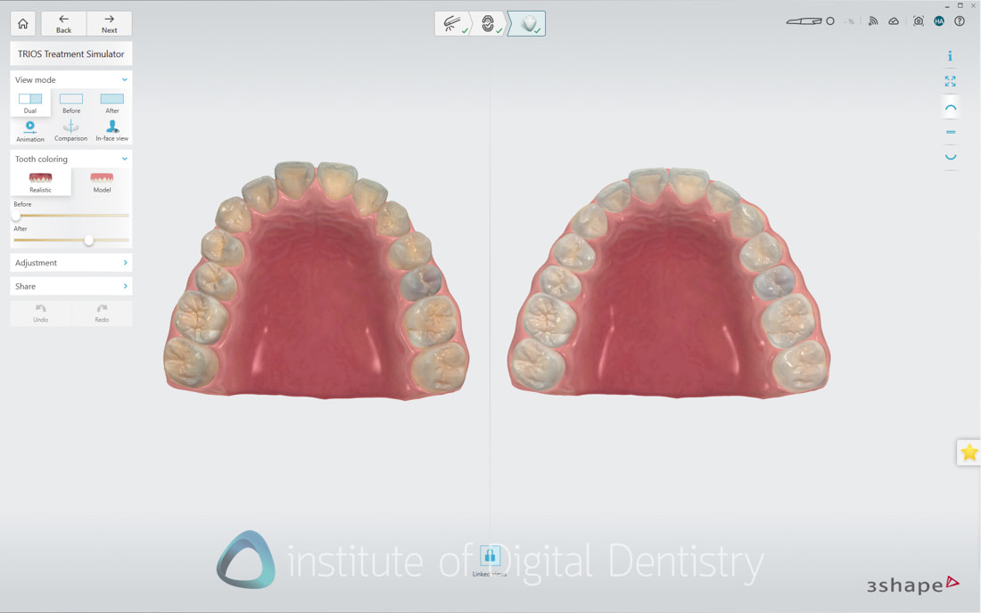 3Shape_TRIOS_6_Review_IDD_Software53