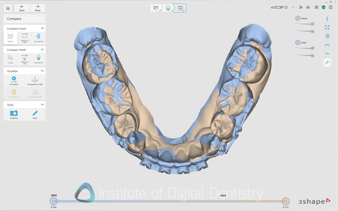3Shape_TRIOS_6_Review_IDD_Software54